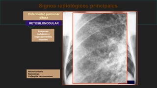 Signos radiológicos principales
Enfermedad pulmonar
difusa
RETICULONODULAR
Imágenes
nodulares y
engrosamientos
septales
Neumoconiosis
Sarcoidosis
Linfangitis carcinomatosa
Sarcoidosis
 