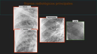 Signos radiológicos principales
Reticulonoduiillar
Reticular
Nodulillar
normal
 