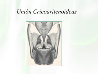 Unión Cricoaritenoideas 