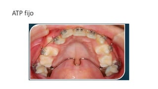 ATP fijo
 