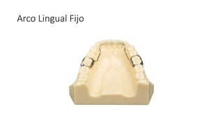 Arco Lingual Fijo
 