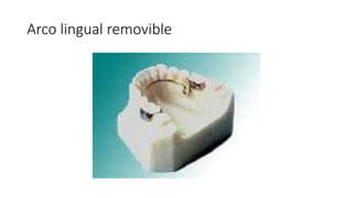 Arco lingual removible
 
