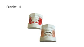 Frankell II
 