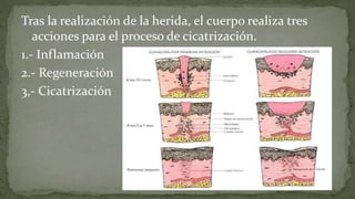 Tras la realización de la herida, el cuerpo realiza tres
acciones para el proceso de cicatrización.
1.- Inflamación
2.- Regeneración
3,- Cicatrización

 