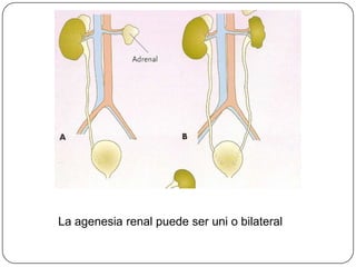 La agenesia renal puede ser uni o bilateral