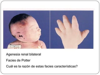 Agenesia renal bilateralFacies de PotterCuál es la razón de estas facies características?