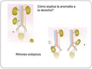Cómo explica la anomalía a la derecha?Riñones ectópicos