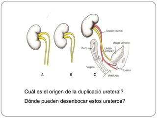 Cuál es el origen de la duplicació ureteral?Dónde pueden desenbocar estos ureteros?