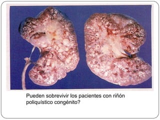 Pueden sobrevivir los pacientes con riñón poliquístico congénito?