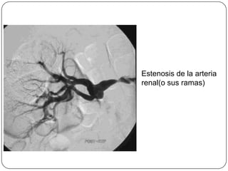 Estenosis de la arteria renal(o sus ramas)