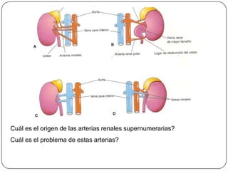 Cuál es el origen de las arterias renales supernumerarias?Cuál es el problema de estas arterias?