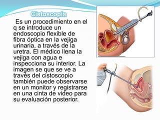 Cistoscopia
 Es un procedimiento en el
q se introduce un
endoscopio flexible de
fibra óptica en la vejiga
urinaria, a través de la
uretra. El médico llena la
vejiga con agua e
inspecciona su interior. La
imagen se que se ve a
través del cistoscopio
también puede observarse
en un monitor y registrarse
en una cinta de video para
su evaluación posterior.
 