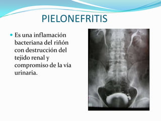 PIELONEFRITIS
 Es una inflamación
  bacteriana del riñón
 con destrucción del
 tejido renal y
 compromiso de la vía
 urinaria.
 