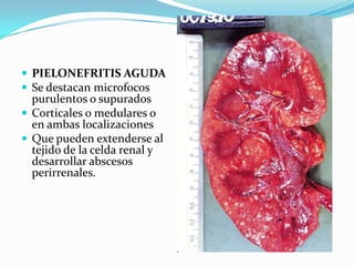  PIELONEFRITIS AGUDA
 Se destacan microfocos
  purulentos o supurados
 Corticales o medulares o
  en ambas localizaciones
 Que pueden extenderse al
  tejido de la celda renal y
  desarrollar abscesos
  perirrenales.
 