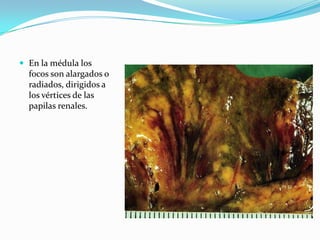  En la médula los
  focos son alargados o
  radiados, dirigidos a
  los vértices de las
  papilas renales.
 