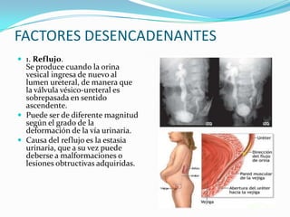 FACTORES DESENCADENANTES
 1. Reflujo.
  Se produce cuando la orina
  vesical ingresa de nuevo al
  lumen ureteral, de manera que
  la válvula vésico-ureteral es
  sobrepasada en sentido
  ascendente.
 Puede ser de diferente magnitud
  según el grado de la
  deformación de la vía urinaria.
 Causa del reflujo es la estasia
  urinaria, que a su vez puede
  deberse a malformaciones o
  lesiones obtructivas adquiridas.
 