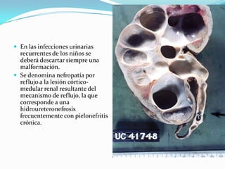  En las infecciones urinarias
  recurrentes de los niños se
  deberá descartar siempre una
  malformación.
 Se denomina nefropatía por
  reflujo a la lesión córtico-
  medular renal resultante del
  mecanismo de reflujo, la que
  corresponde a una
  hidroureteronefrosis
  frecuentemente con pielonefritis
  crónica.
 