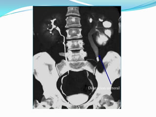 Dilatacion ureteral
 