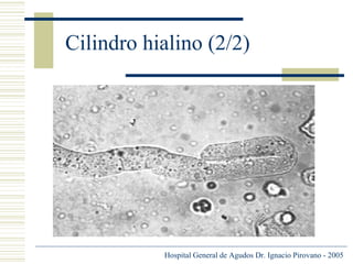 Cilindro hialino (2/2)

Hospital General de Agudos Dr. Ignacio Pirovano - 2005

 
