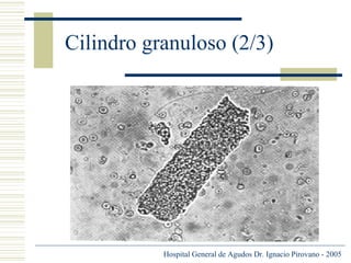 Cilindro granuloso (2/3)

Hospital General de Agudos Dr. Ignacio Pirovano - 2005

 