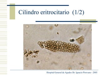 Cilindro eritrocitario (1/2)

Hospital General de Agudos Dr. Ignacio Pirovano - 2005

 