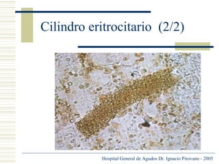Cilindro eritrocitario (2/2)

Hospital General de Agudos Dr. Ignacio Pirovano - 2005

 