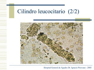 Cilindro leucocitario (2/2)

Hospital General de Agudos Dr. Ignacio Pirovano - 2005

 