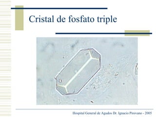 Cristal de fosfato triple

Hospital General de Agudos Dr. Ignacio Pirovano - 2005

 