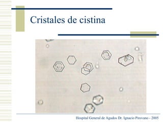 Cristales de cistina

Hospital General de Agudos Dr. Ignacio Pirovano - 2005

 