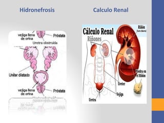 Hidronefrosis Calculo Renal
 