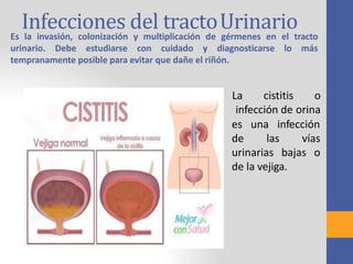 Infecciones del tractoUrinarioEs la invasión, colonización y multiplicación de gérmenes en el tracto
urinario. Debe estudiarse con cuidado y diagnosticarse lo más
tempranamente posible para evitar que dañe el riñón.
La cistitis o
infección de orina
infecciónes una
de las vías
urinarias bajas o
de la vejiga.
 