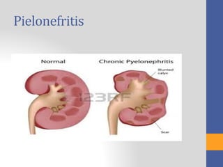 Pielonefritis
 