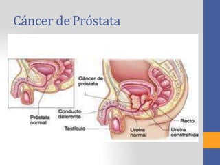Cáncer dePróstata
 