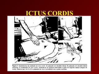 ICTUS CORDIS
 