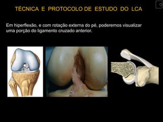 TÉCNICA E PROTOCOLO DE ESTUDO DO LCA

Em hiperflexão, e com rotação externa do pé, poderemos visualizar
uma porção do ligamento cruzado anterior.
 