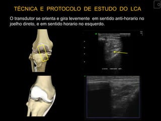 TÉCNICA E PROTOCOLO DE ESTUDO DO LCA
O transdutor se orienta e gira levemente em sentido anti-horario no
joelho direto, e em sentido horario no esquerdo.
 