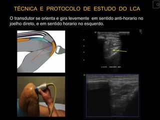 TÉCNICA E PROTOCOLO DE ESTUDO DO LCA
O transdutor se orienta e gira levemente em sentido anti-horario no
joelho direto, e em sentido horario no esquerdo.
 