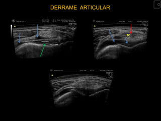 DERRAME ARTICULAR




                    TC
 
