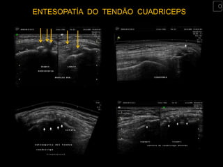 ENTESOPATÍA DO TENDÃO CUADRICEPS
 