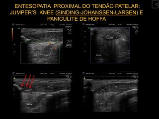 ENTESOPATIA PROXIMAL DO TENDÃO PATELAR:
JUMPER’S KNEE (SINDING-JOHANSSEN-LARSEN) E
            PANICULITE DE HOFFA
 