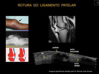 ROTURA DO LIGAMENTO PATELAR




              Imagens gentilmente cedidas pelo Dr. Monres Jose Gomes
 