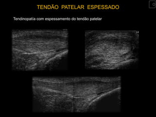 TENDÃO PATELAR ESPESSADO

Tendinopatía com espessamento do tendão patelar
 