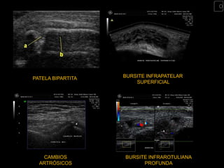 PATELA BIPARTITA   BURSITE INFRAPATELAR
                       SUPERFICIAL




   CAMBIOS         BURSITE INFRAROTULIANA
  ARTRÓSICOS             PROFUNDA
 