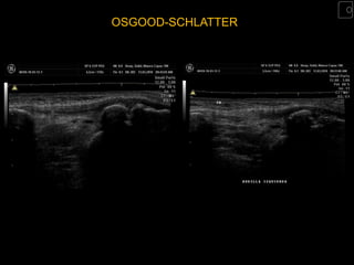 OSGOOD-SCHLATTER
 