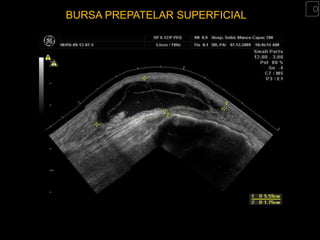BURSA PREPATELAR SUPERFICIAL
 