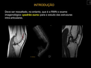 INTRODUÇÃO

Deve ser ressaltado, no entanto, que é a RMN o exame
imagenológico «padrão ouro» para o estudo das estruturas
intra-articulares.
 