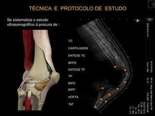TÉCNICA E PROTOCOLO DE ESTUDO

Se sistematiza o estudo
ultrasonográfico à procura de :



                                  TC

                                  CARTILAGEM

                                  ENTESE TC

                                  BPPS

                                  ENTESE TP

                                  TP

                                  BIPS

                                  BIPP

                                  HOFFA

                                  TAT
 