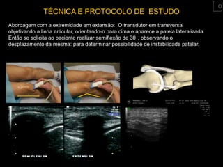 TÉCNICA E PROTOCOLO DE ESTUDO
Abordagem com a extremidade em extensão: O transdutor em transversal
objetivando a linha articular, orientando-o para cima e aparece a patela lateralizada.
Então se solicita ao paciente realizar semiflexão de 30 , observando o
desplazamento da mesma: para determinar possibilidade de instabilidade patelar.
 