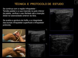 TÉCNICA E PROTOCOLO DE ESTUDO
Se continua com a região infrapatelar :
Tendão patelar e a sua insercão no polo inferior
da patela, verificar o seu fibrilado até a inserção
distal na tuberosidade anterior da tibia.

Se evalúa a gordura de Hoffa, e a integridade
das bursas infrapatelar superficial e infrapatelar
profunda.
 