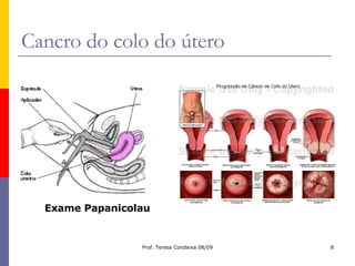 Cancro do colo do útero Exame Papanicolau 